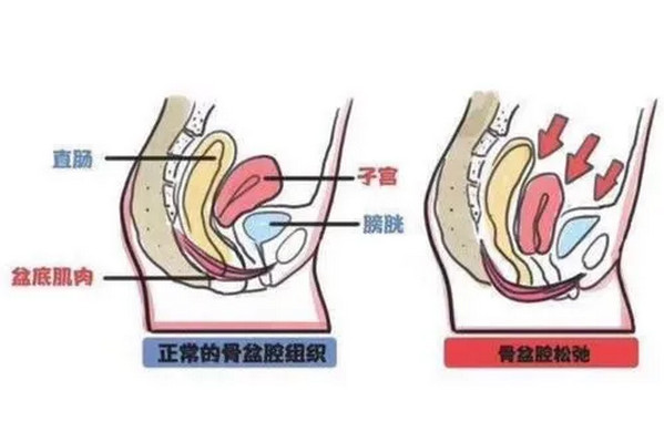 盆底肌修复有必要花钱去做吗？_3